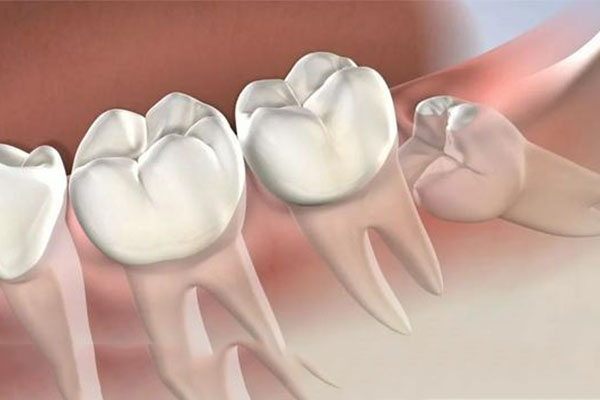 拔智齿要注意哪些事项呢？中老年口