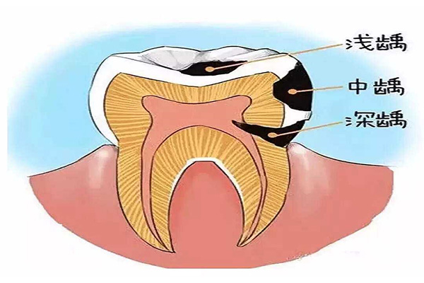 蛀牙是怎么产生的？幼儿园小朋友的