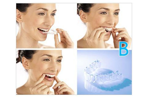 周口牙齿正畸医院排名揭晓！中老年口腔批量修复效率高，缺牙