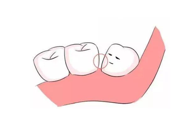 横位智齿不拔真不行？中老年口腔批