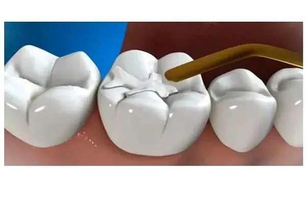 儿童牙齿涂氟挂什么科？别挂错，中