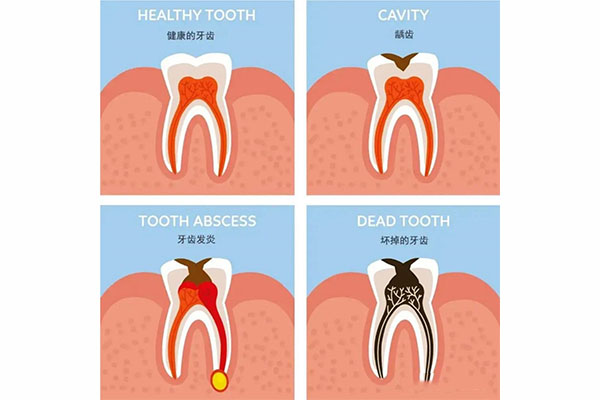 蛀牙疼喷什么药好？中老年口腔批量修复方案让缺牙不再困扰