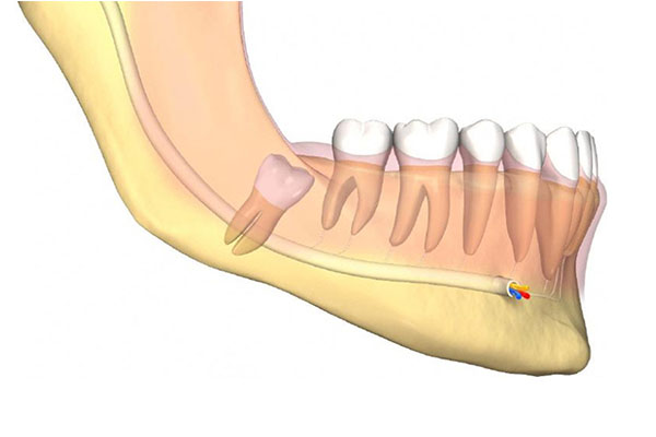 智齿是正常的牙齿吗？中老年口腔为您解答缺牙难题