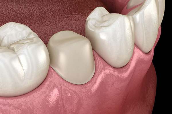 牙齿缺损一小块补牙要磨牙吗？费用多少？中老年口腔高效批量