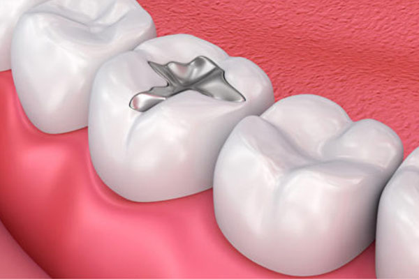 牙齿涂氟的危害与后果，中老年口腔