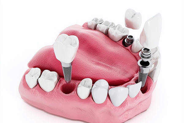 种牙二期手术时间真的比一期长吗？