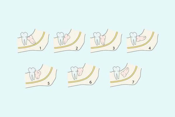 智齿拔除能用医保报销吗 中老年口腔