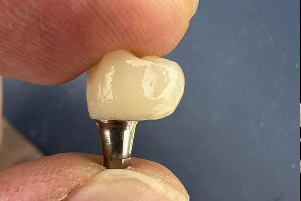 种牙得多少钱一颗？中老年口腔批量种牙效率高更划算