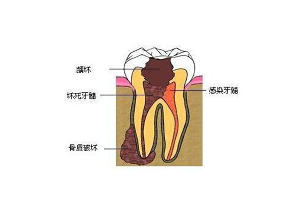 中老年口腔：蛀牙止痛最快方法有哪