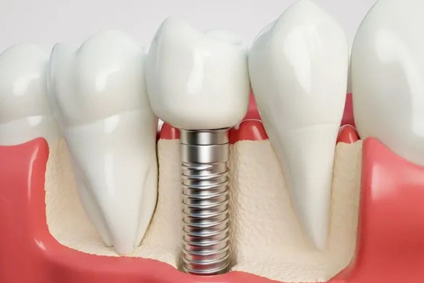 做牙冠不等于种牙 中老年口腔批量修