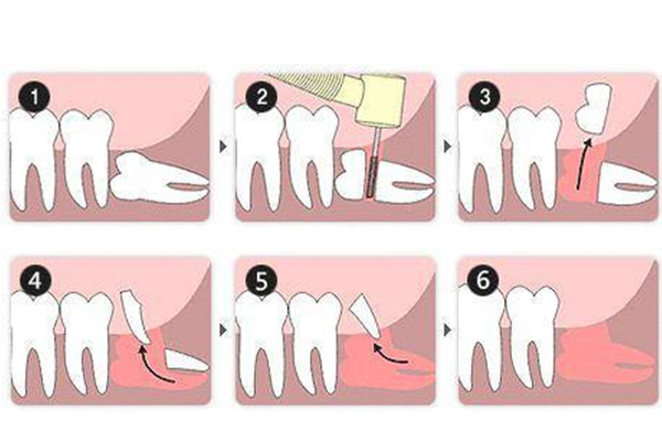 小孩子长智齿是怎么回事？【中老年口腔】教您如何应对和解决