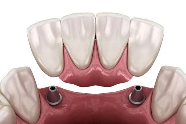 拔牙后多久能镶牙？中老年口腔教您最快解决方法！