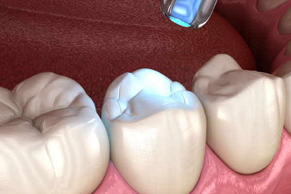 氟斑牙能涂氟吗？中老年口腔专业方案揭秘