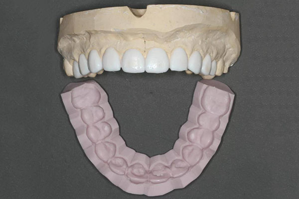 半口活动假牙多少钱？中老年口腔为您解答！