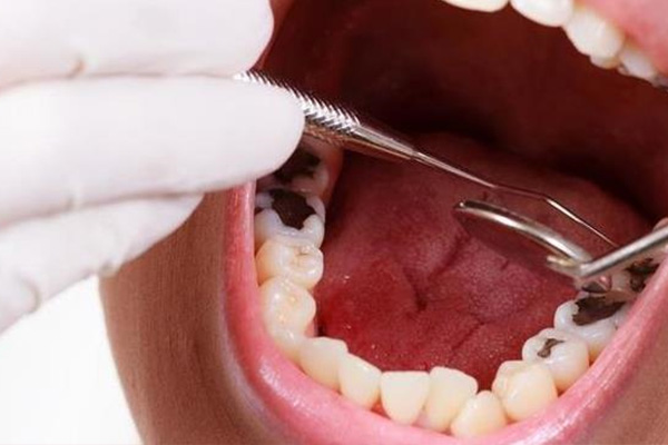 牙齿长蛀牙怎么办？中老年口腔批量修复方案高效又省心