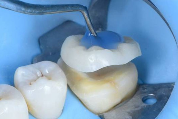 补一颗牙齿多久能完成？中老年口腔批量修复技术实现3分钟高效