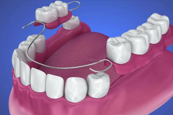 固定镶牙 vs 活动镶牙，哪个更适合缺