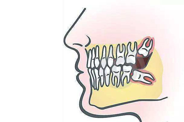 智齿拍片多少钱一次？中老年口腔为