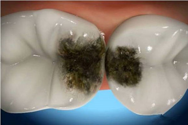 儿童乳牙蛀牙怎么处理比较好？中老年口腔为您解忧