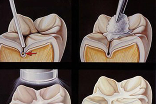 牙涂氟的利与弊：中老年缺牙患者的