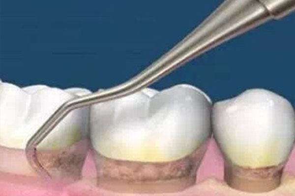 缺牙修复新突破：中老年口腔批量高效解决方案，告别牙齿缺失
