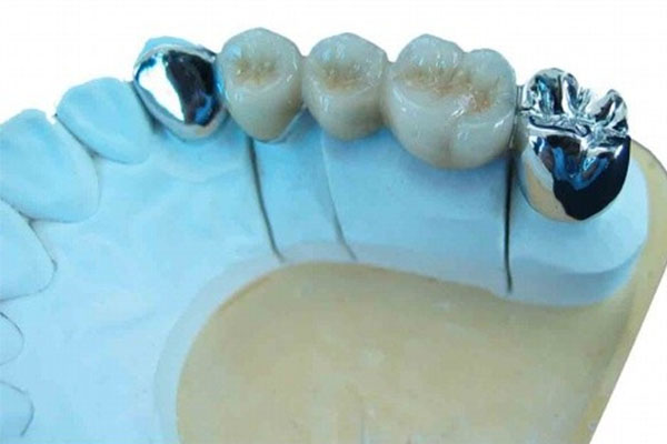 镶牙 vs 种牙：中老年缺牙患者的高效