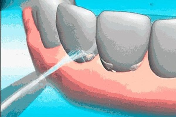 洗牙工具推荐：中老年口腔的高效解