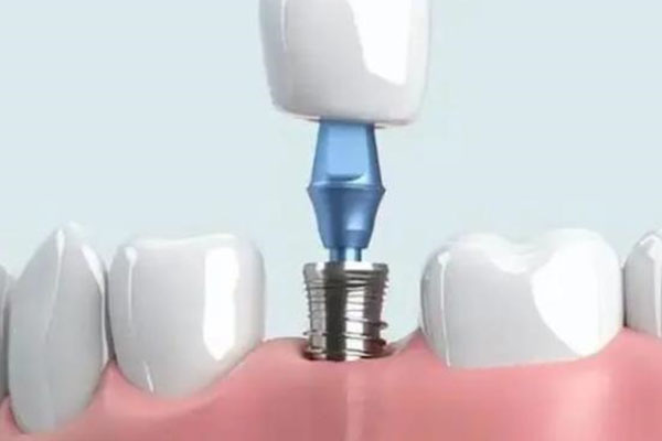 北京种牙多少钱一颗牙？中老年口腔