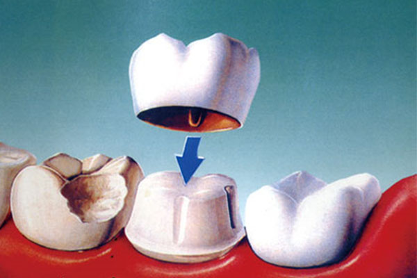 刷牙发现牙齿缺损不疼也要补牙？中