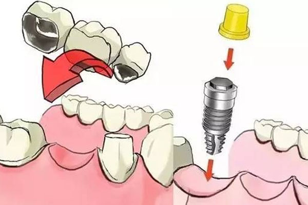 种牙当天能不能同房？中老年口腔为