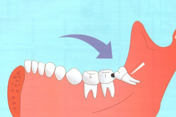 什么年龄段容易长智齿和智齿烦恼？