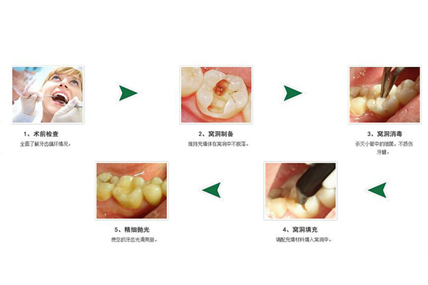 儿童涂氟到底要涂多少次才好？中老
