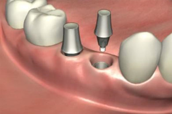 广西医科大学种牙价格揭秘：中老年