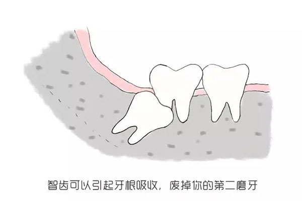 中老年人拔智齿后注意事项及饮食指
