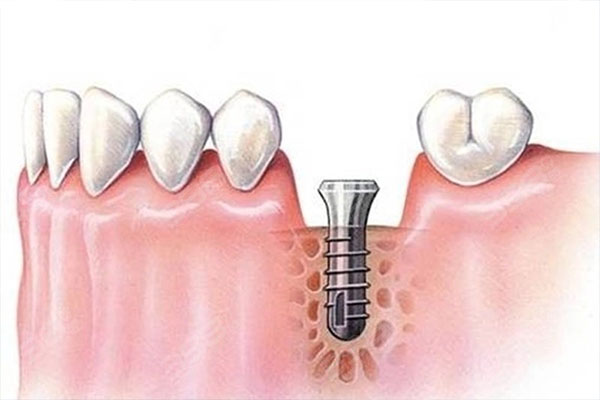 种牙医保可以报销多少？中老年口腔