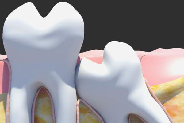 智齿拔了之后留下的洞怎么办？中老年口腔专家教你正确护理方