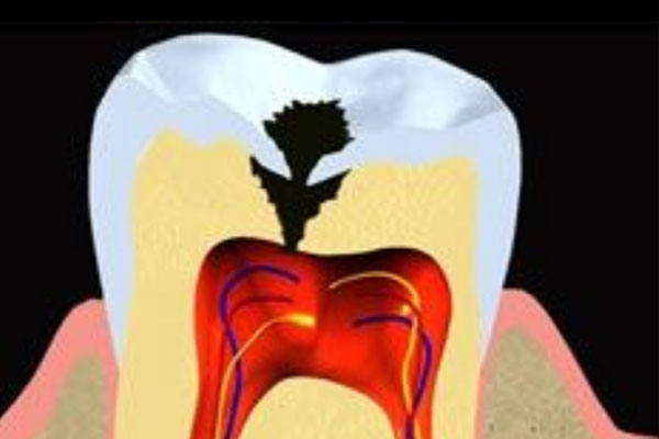 4岁蛀牙到底该不该补？别等换牙期耽误孩子健康！