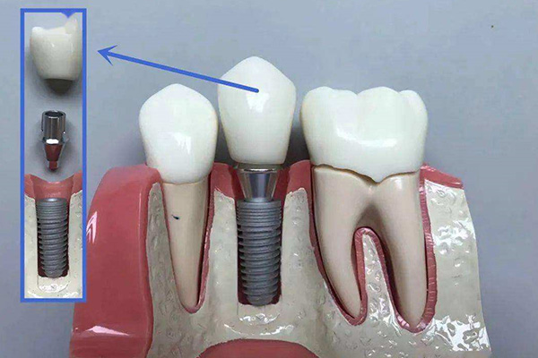 在医院种牙能享受医疗报销吗多少钱