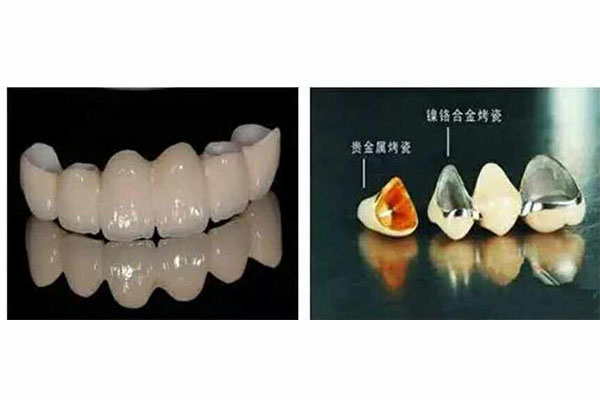 镶牙材质大揭秘：哪种更适合中老年