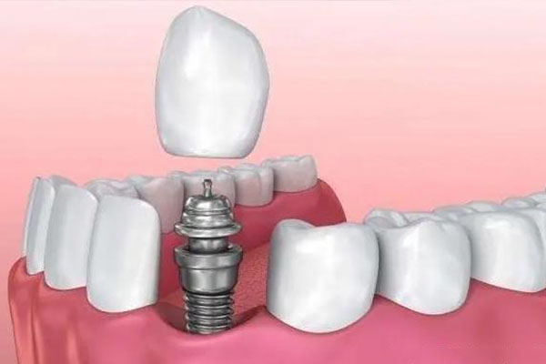 深圳医保种牙能报销吗？中老年口腔批量种牙效率高更省钱