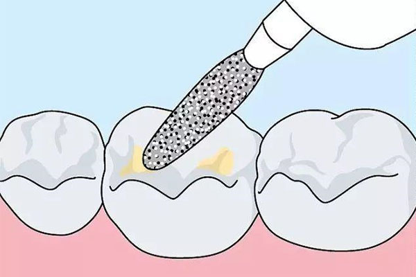 儿童牙齿涂氟真的安全吗？家长必看的副作用解析！