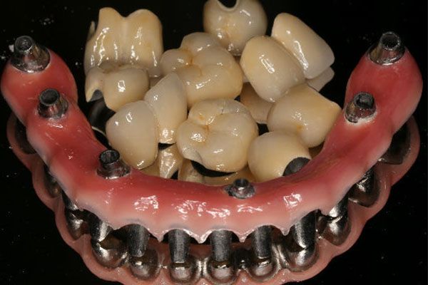 种牙多少钱一颗大概多久完成手术