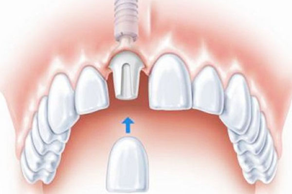 牙缺失不用愁，除了种牙还有这些高效修复方案！