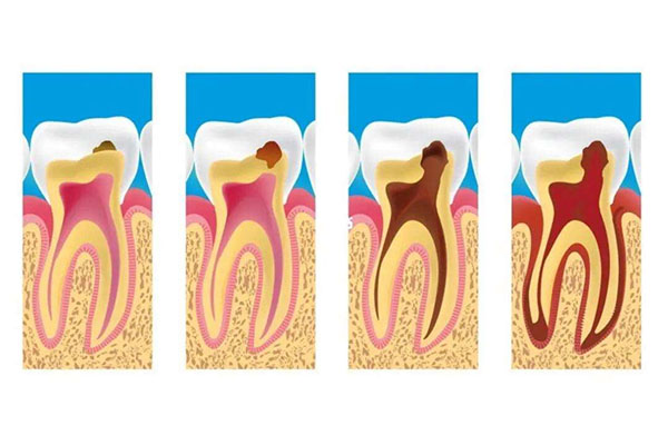 孩子蛀牙反复发作？中老年口腔批量修复技术让家长不再焦虑