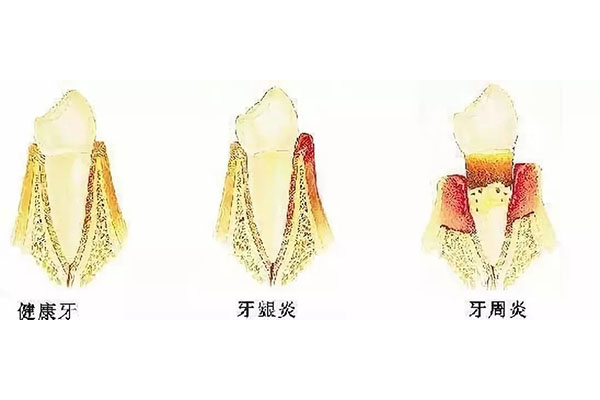 治疗牙周炎别光靠吃药！中老年口腔