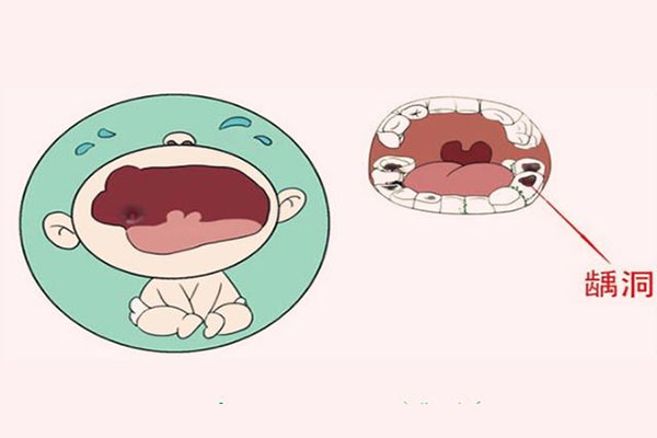 孩子蛀牙补牙费用揭秘，中老年口腔专家帮你算笔明白账