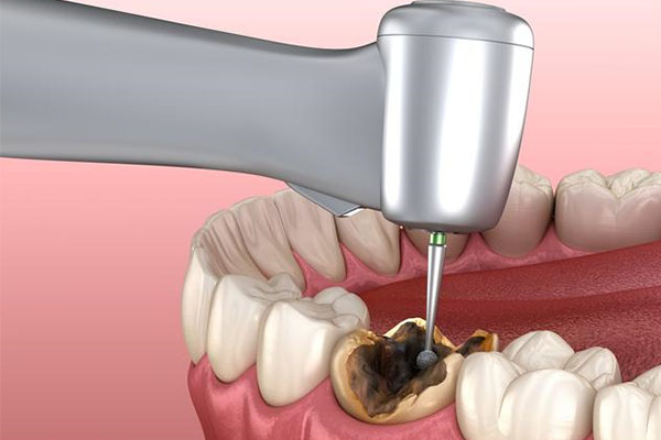 中老年口腔：蛀牙到底是拔还是补？