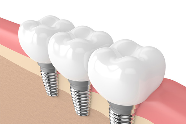 中老年缺牙到底做哪种牙好些？一文看懂选择不纠结