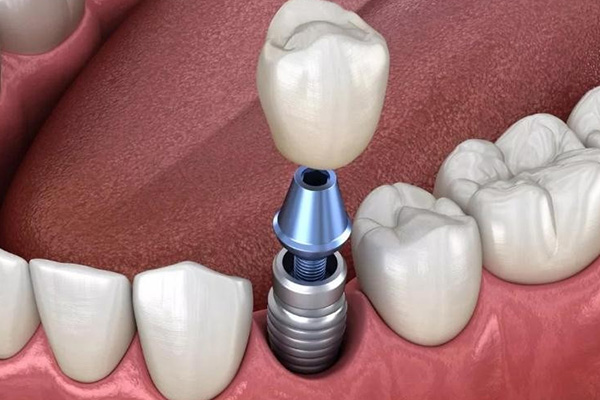 种牙集采是什么意思？中老年缺牙患