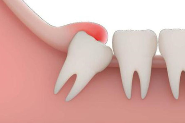 拔智齿后牙洞多久能长好？中老年口